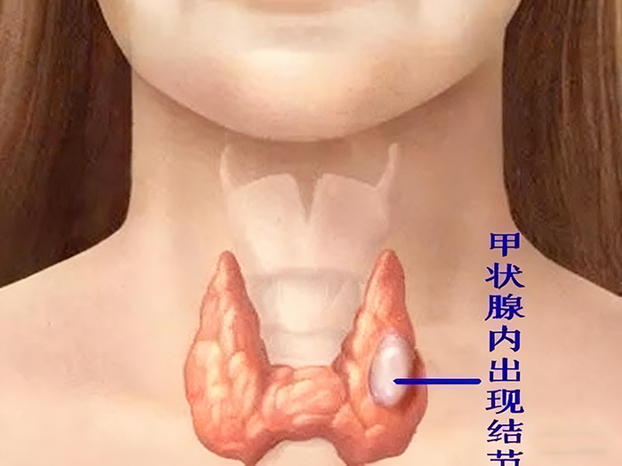 甲状腺结节的危害不可忽视 甲状腺结节的危害不可忽视